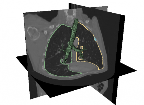 Lung Image Analysis